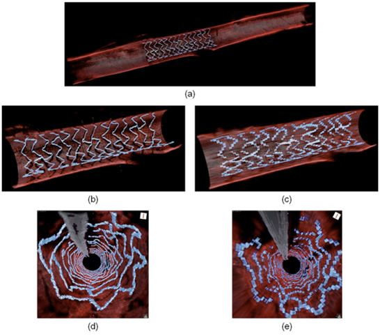 Figure 1. Three-dimensional, volume-rendered intravascular OFDI images acquired in vivo. (a) Longitudinal cutaway view of a 45-mm-long rabbit aorta acquired in 3.7 seconds with an imaging pitch of 34μm. Longitudinal cutaway views of the stented-vessel segment with (b) 34 μm (c) 200μm longitudinal pitches, respectively. Fly-through views of the same stented-vessel segment with (d) 34 μm and (e) 200μm longitudinal pitches, respectively.