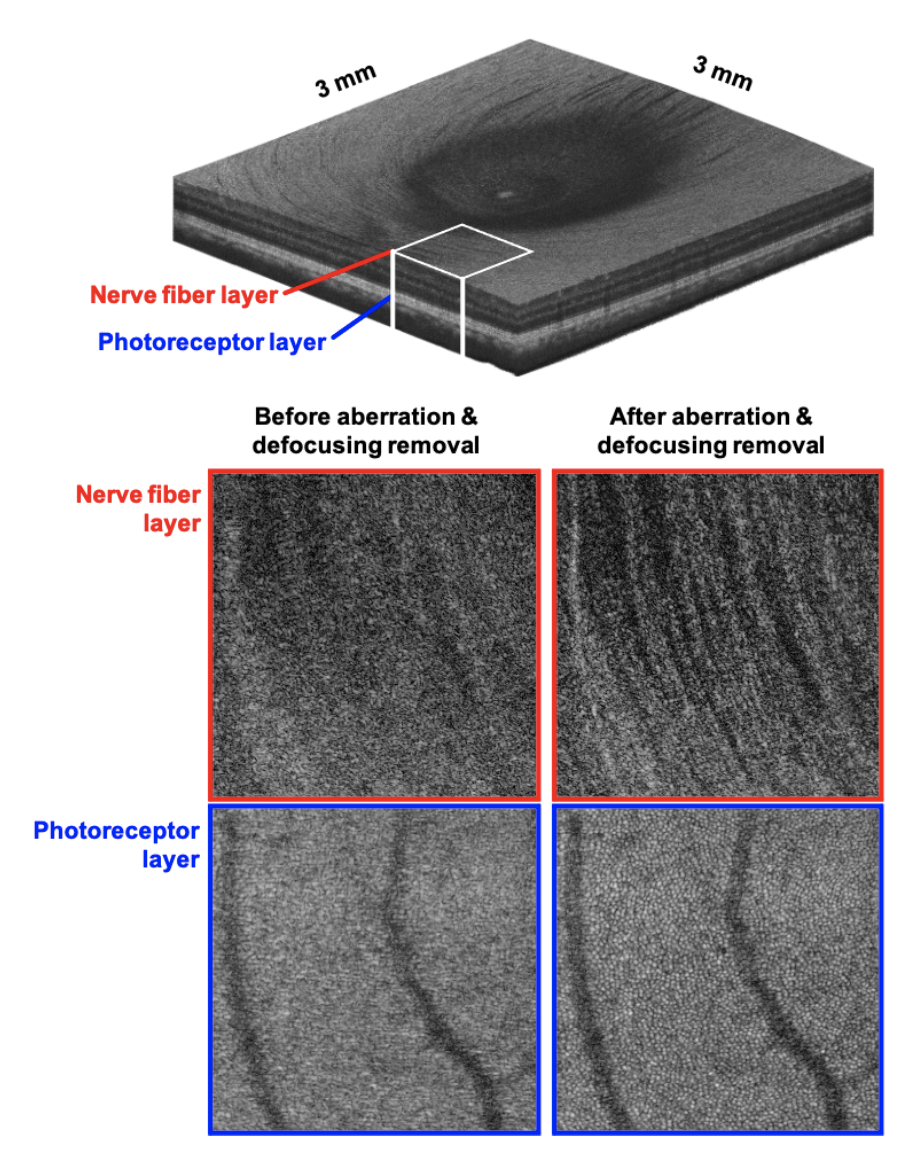 Figure 1. Wide-field three-dimensional depth-invariant cellular-resolution retinal imaging. (Top) 3D rendering of 3 × 3 mm retinal volume centered at the fovea imaged in a single acquisition. (Bottom) Retinal nerve fiber layer (RNFL) and photoreceptor layer (PRL) projections of a 600 × 600 μm2 subvolume before and after computational defocus and aberration removal. 